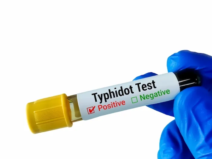 typhoid test